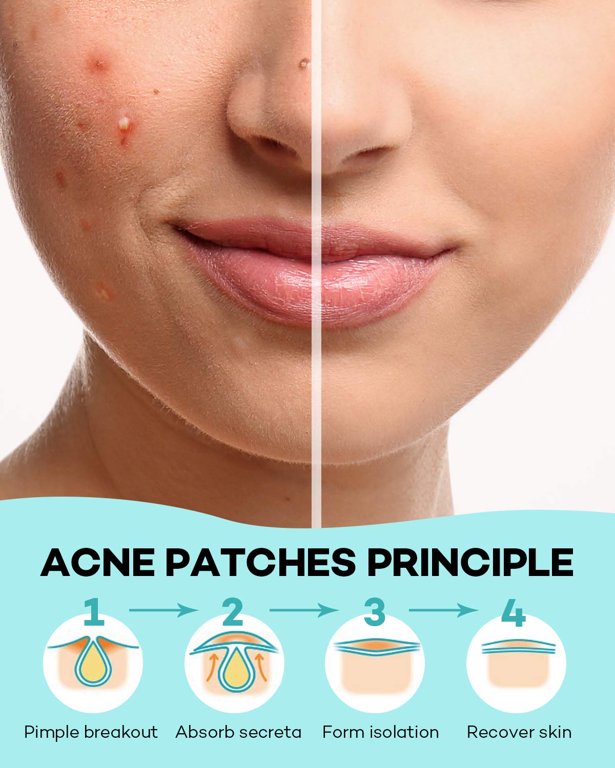 1724480537 678 Acne Patch Pimple Patch 4 Sizes 140 Patches Acne Absorbing