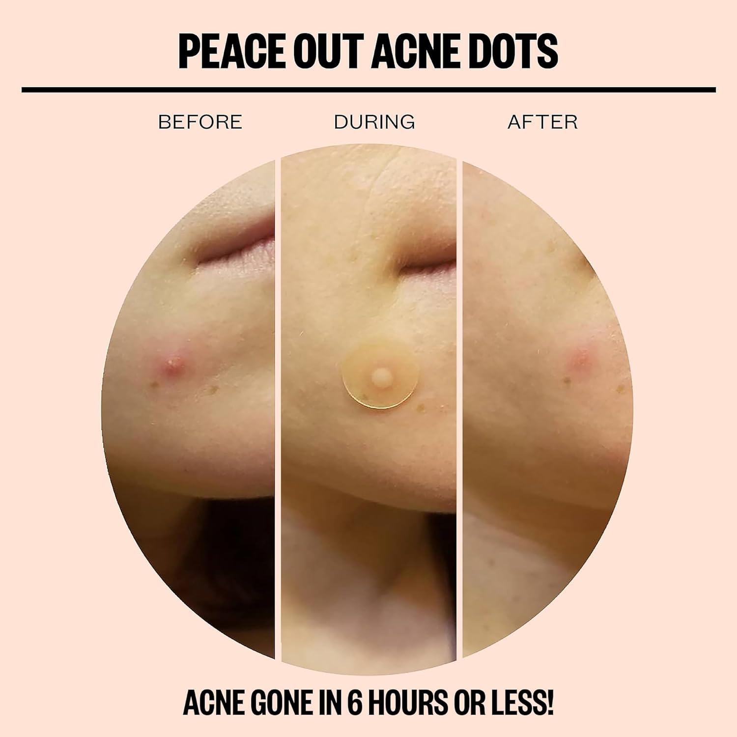 1724594327 691 Peace Out Skincare Acne Dots Hydrocolloid Pimple Patches Help Clear